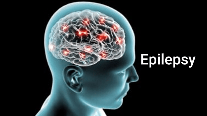 Epilepsy