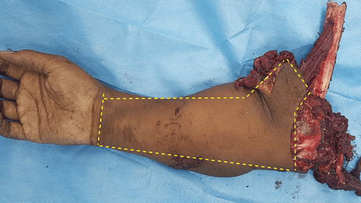Amputated arm