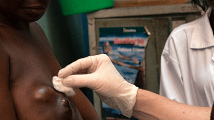 Breast cancer patients in Africa