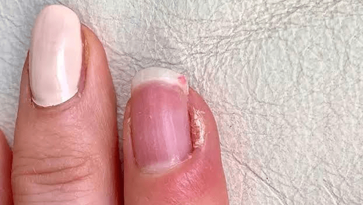 fingernail