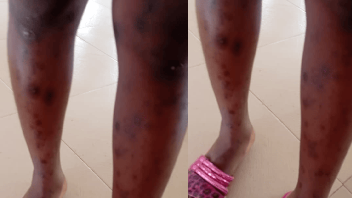 Mrs Adebowale shows the legs of her daughter covered in marks from her time in captivity.