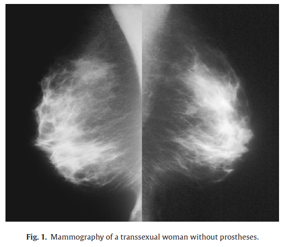 Breast growth is a significant physical endpoint in the hormonal treatment of transgender women. Trans Women Breast Growth Studies Gender Analysis