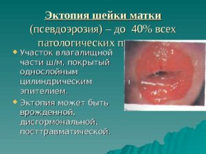От чего появляется эрозия шейки. Из-за чего возникает эрозия шейки матки