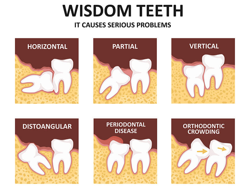 Wisdom teeth are the third pair of molars to grow in, and appear between the ages of 17 and 21. Wisdom Teeth Why We Have Them And When To Remove Them Hamburg Dental Care