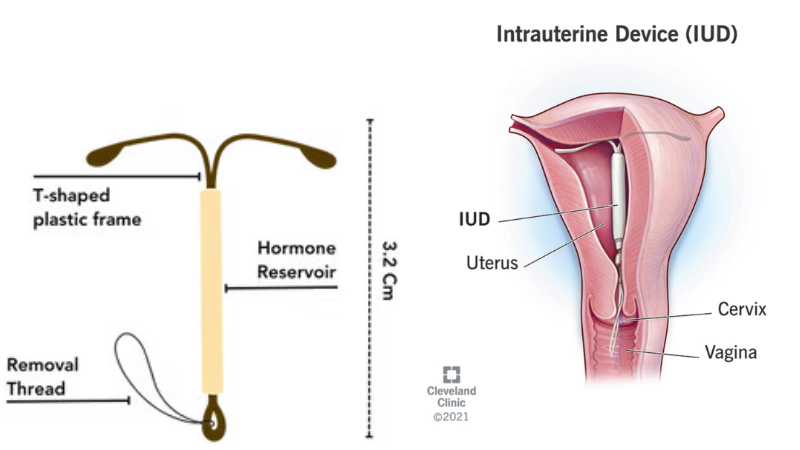 Merk dan Harga IUD Hormonal (medicalnewstoday.com)