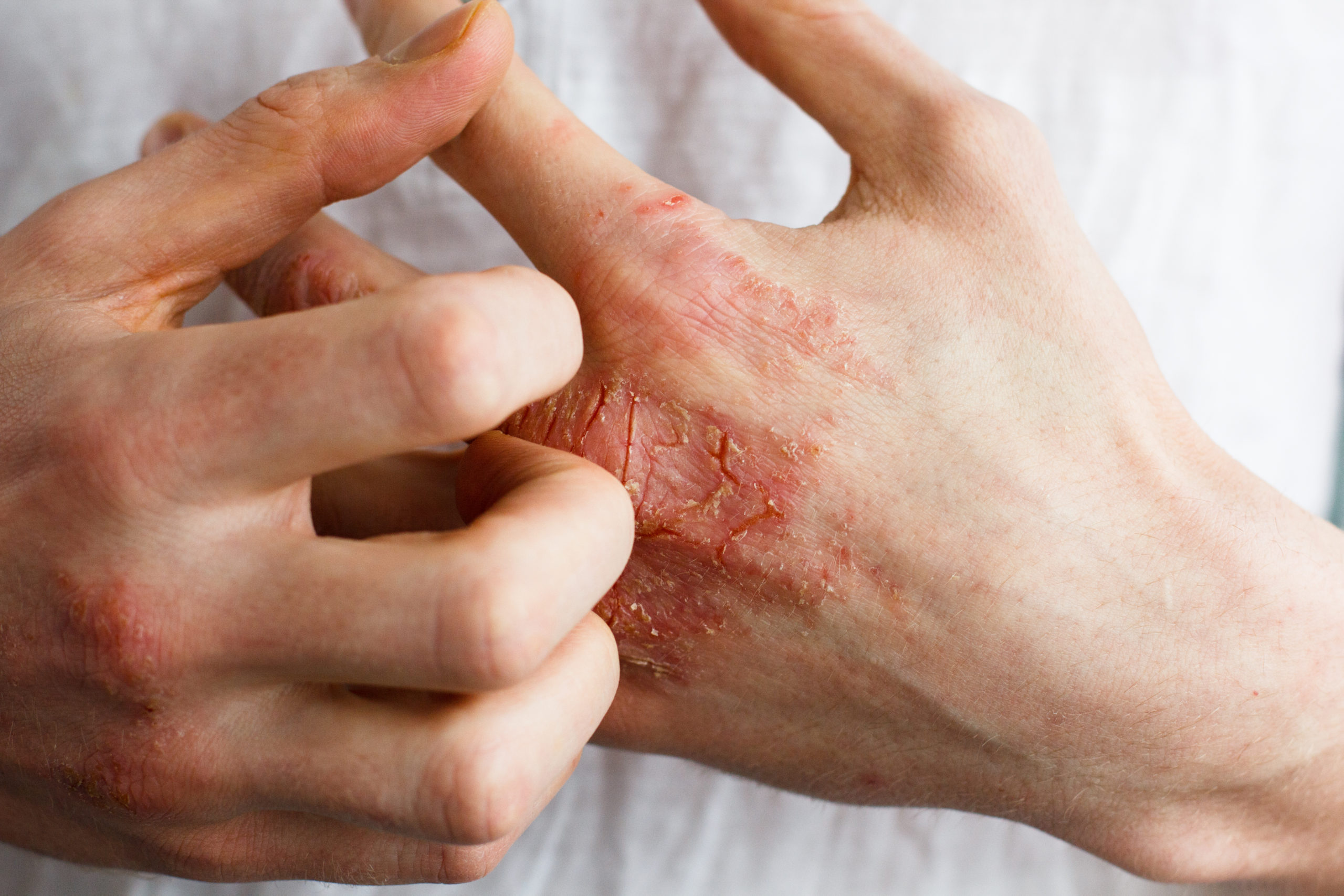 Nickel is one of the most common causes of allergic contact dermatitis: Everything You Need To Know About Managing Eczema Selfdecode Health
