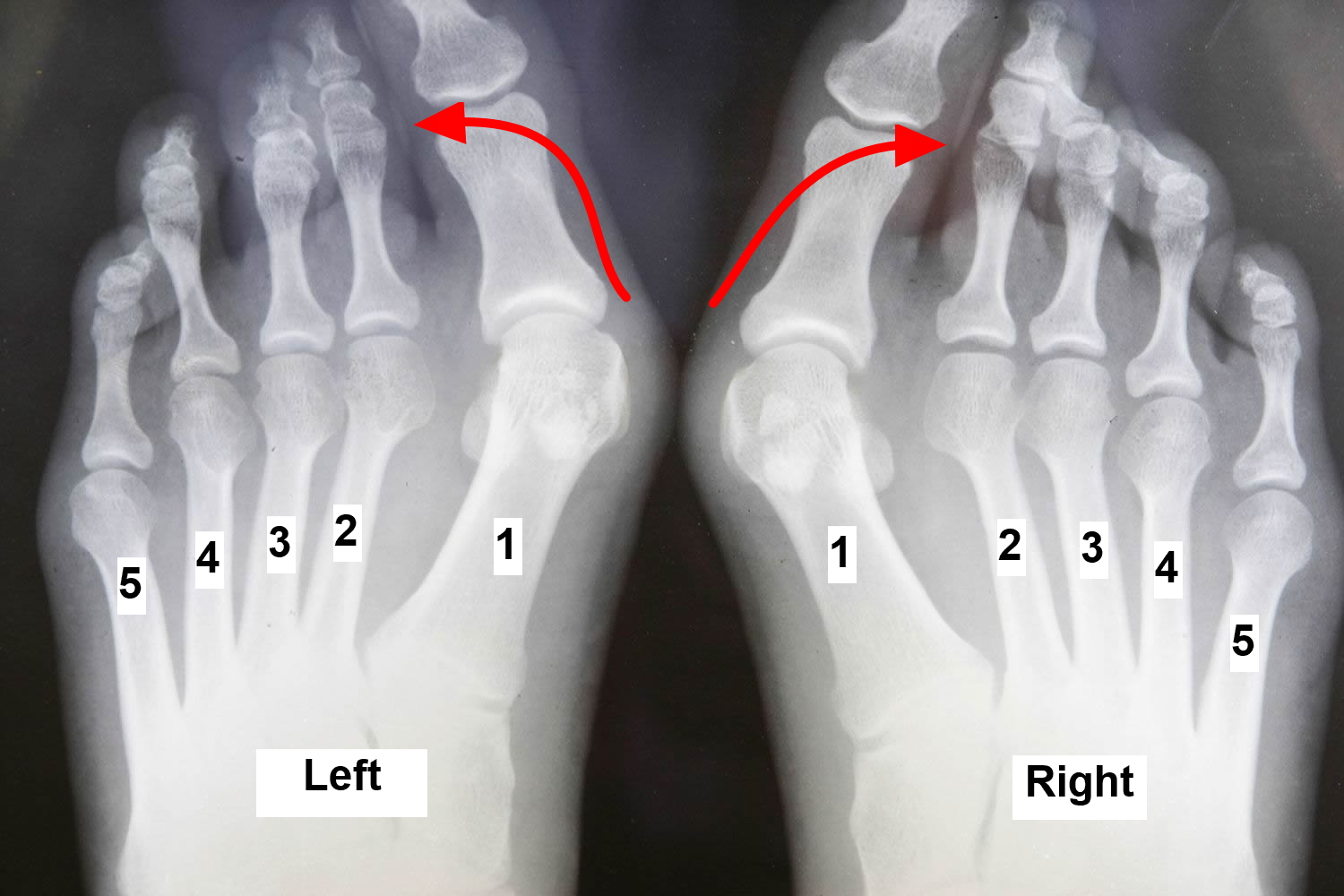 Livestrong.com creative if you're one of the estimated quarter of adults who have a bunion, per the journal of foot and ankle research , you know how pesky a problem this can be — especially when it comes to wearing shoes. Foot Bunion - Causes, Symptoms, and Treatment To Correct Bunion