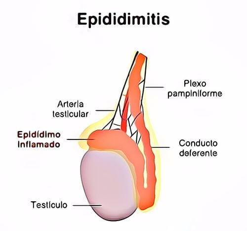 Obat Epididimitis Resep Herbal HNI HPAI - Herbalismart