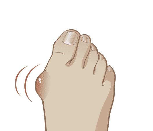 “Кісточки” на ногах