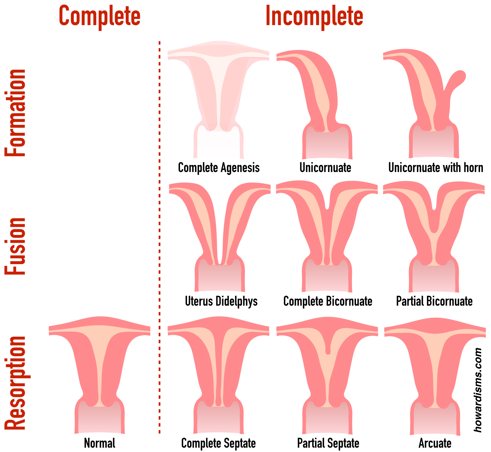 Kelainan rahim adalah salah satu penyebab wanita susah hamil. Four Tips For Correctly Diagnosing Uterine Anomalies