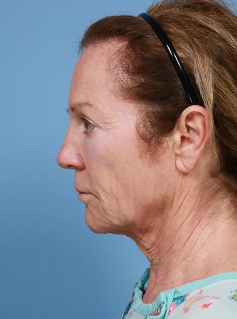 Before Deep Plane Facelift