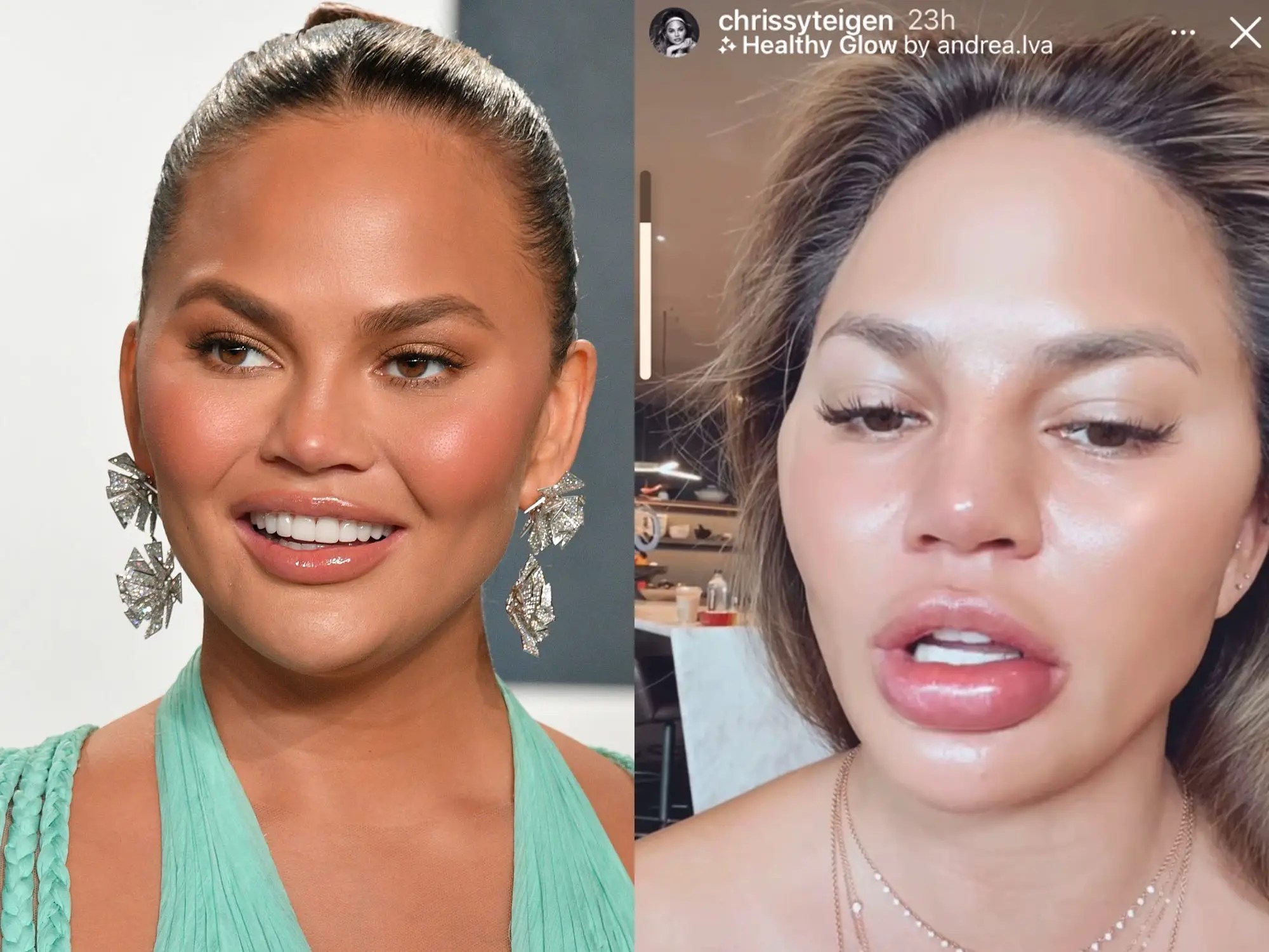 The pain from your canker sore should decrease in 7 to 10 days, and it should heal . Chrissy Teigen S Swollen Lips Could Be New Orange Allergy Expert Says