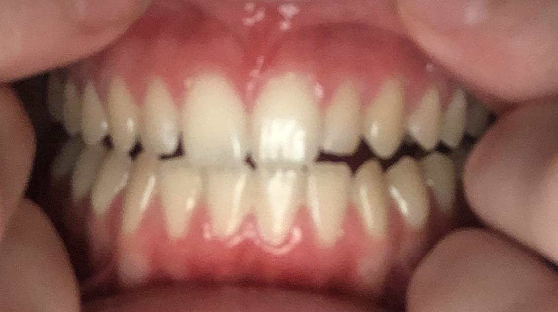 How To Reverse Gum Disease Reddit