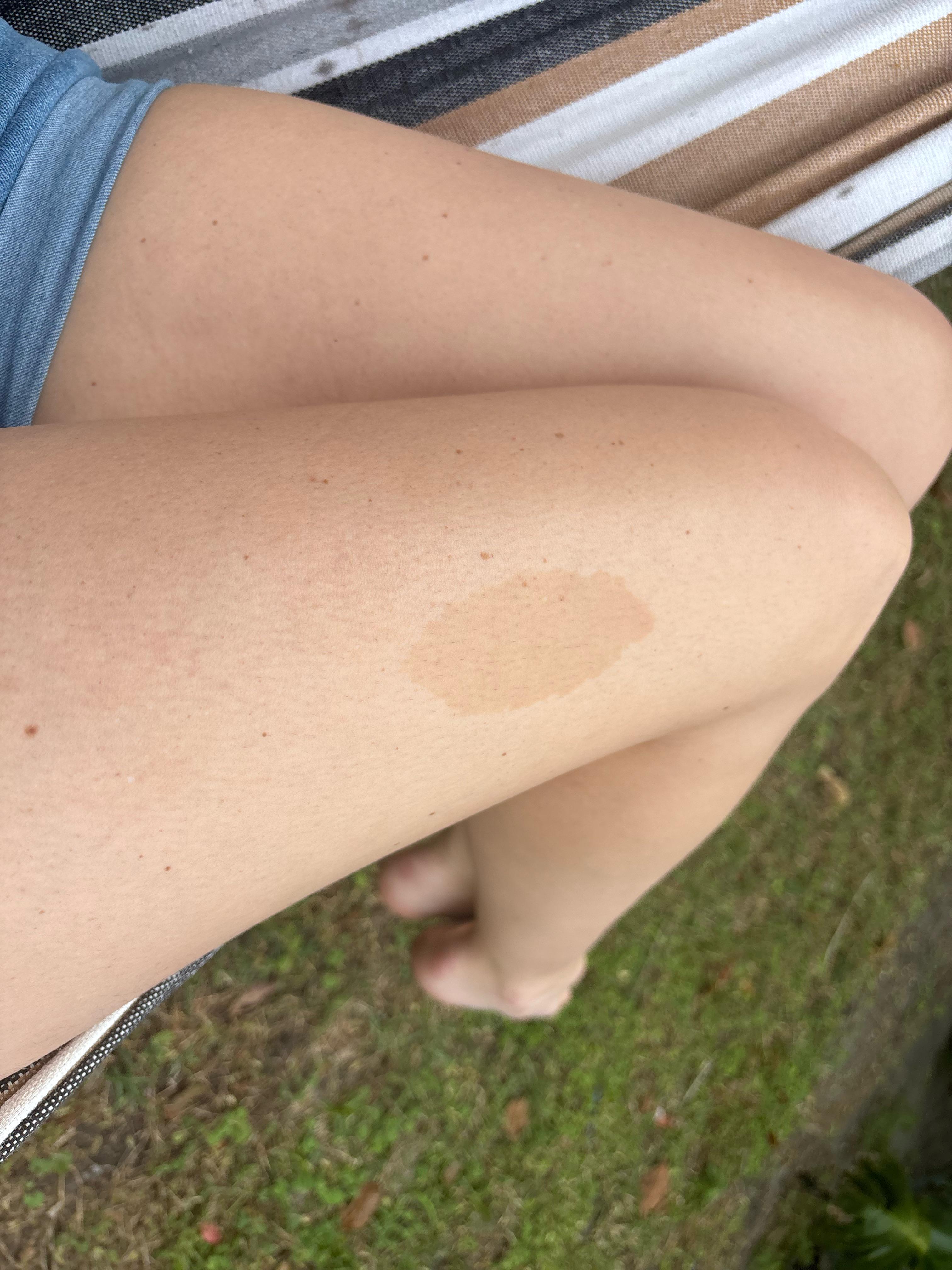 Beyond skin-deep- birthmark allure on buttocks