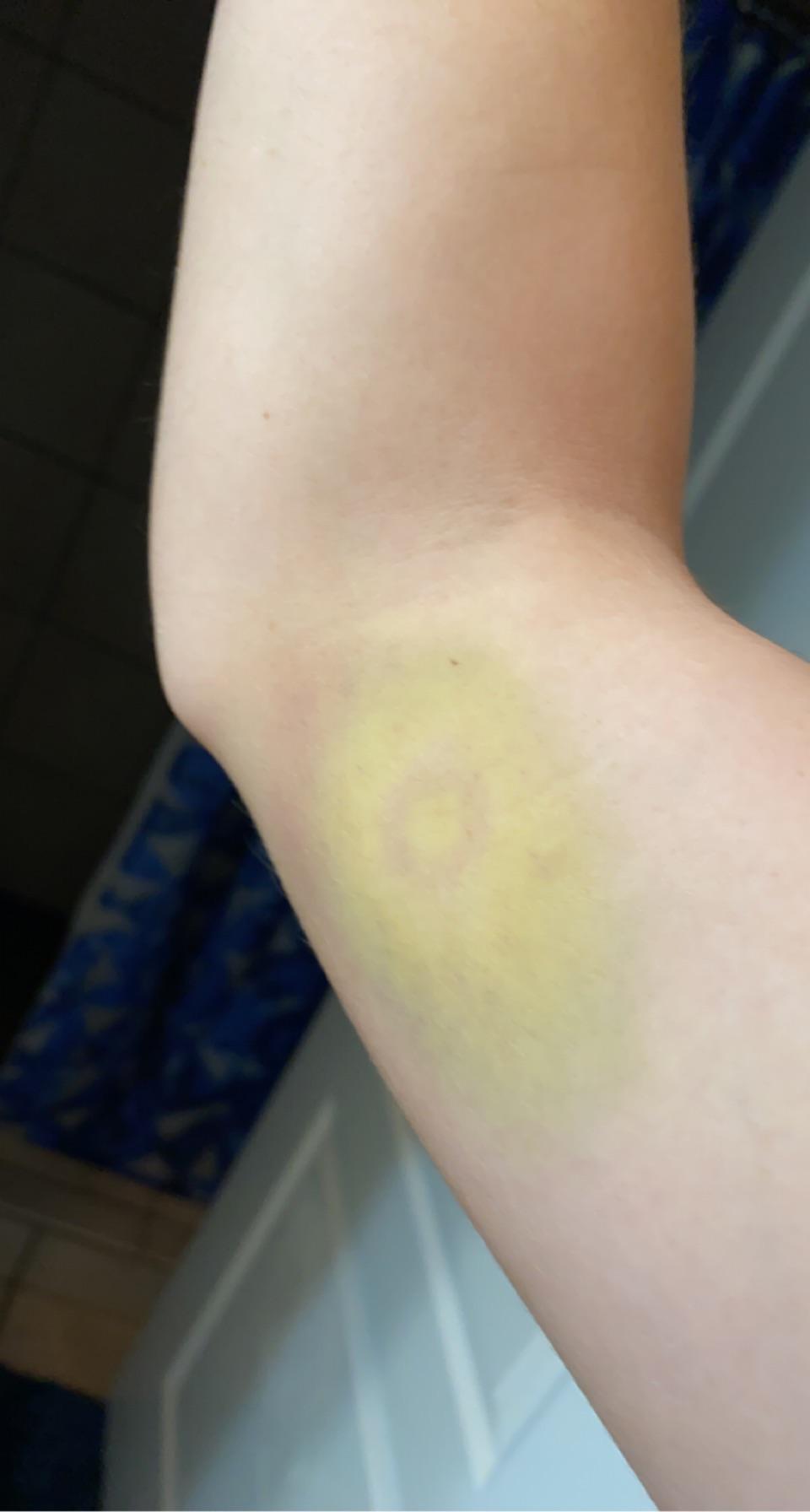 If you feel like you have to cough, hold a pillow to your ribs to minimize movement and pain. My Bruise From Paintball Looks Like An Avocado R Mildlyinteresting