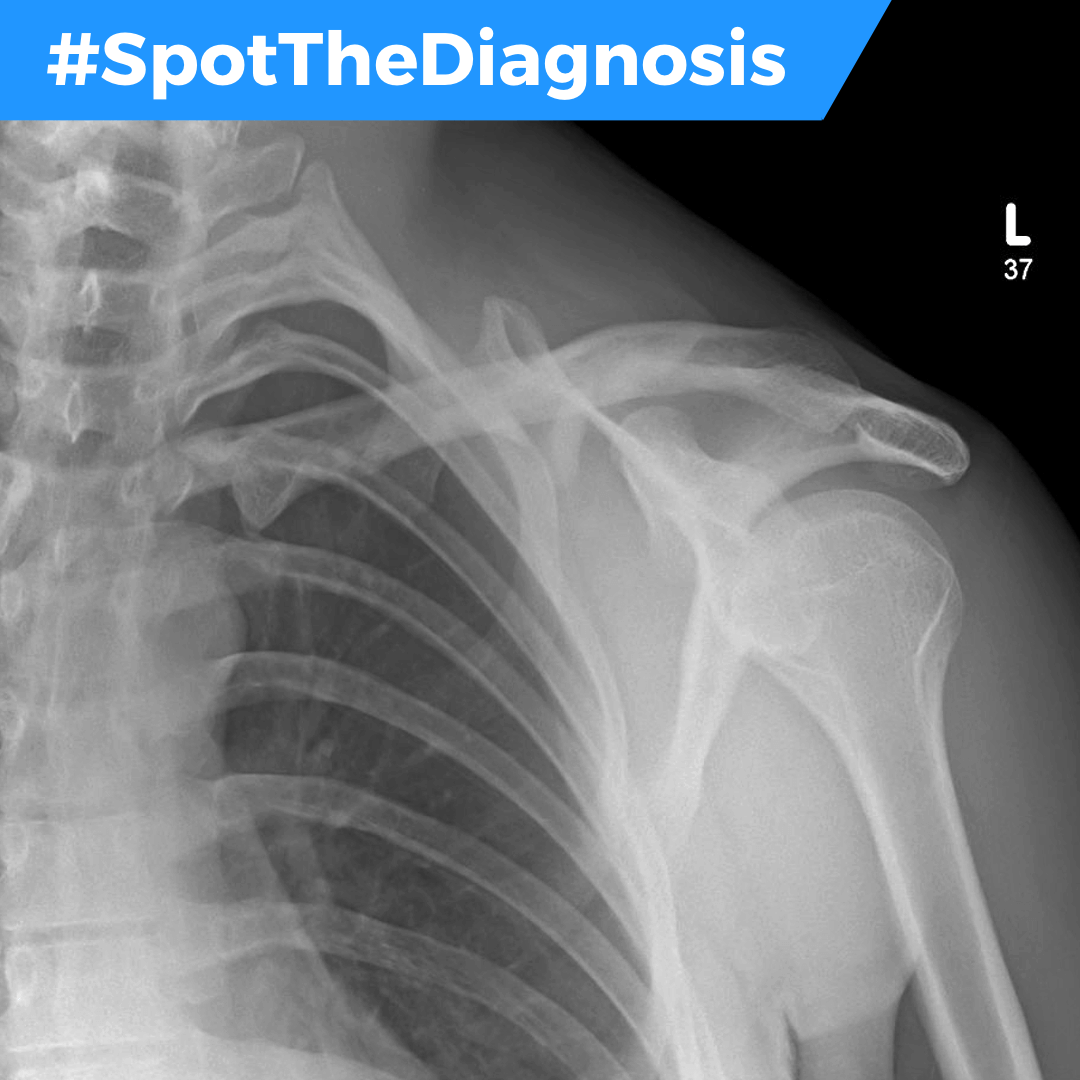 Quiz 25 Year Old Man On A Night Out With Friends Has Fallen From A Bucking Bronco Machine Onto His Shoulder Can You Spotthediagnosis Emergencymedicine
