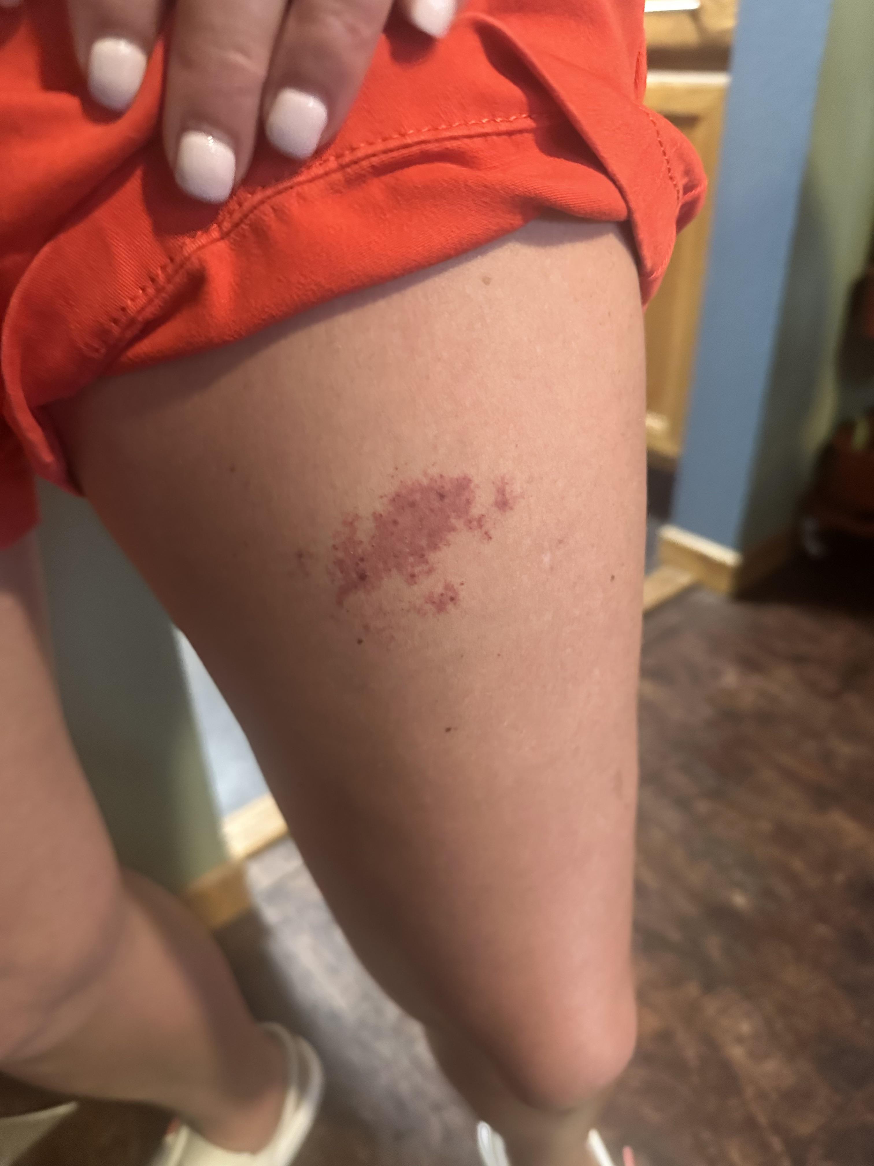 Intriguing insights into love mark meanings on buttocks