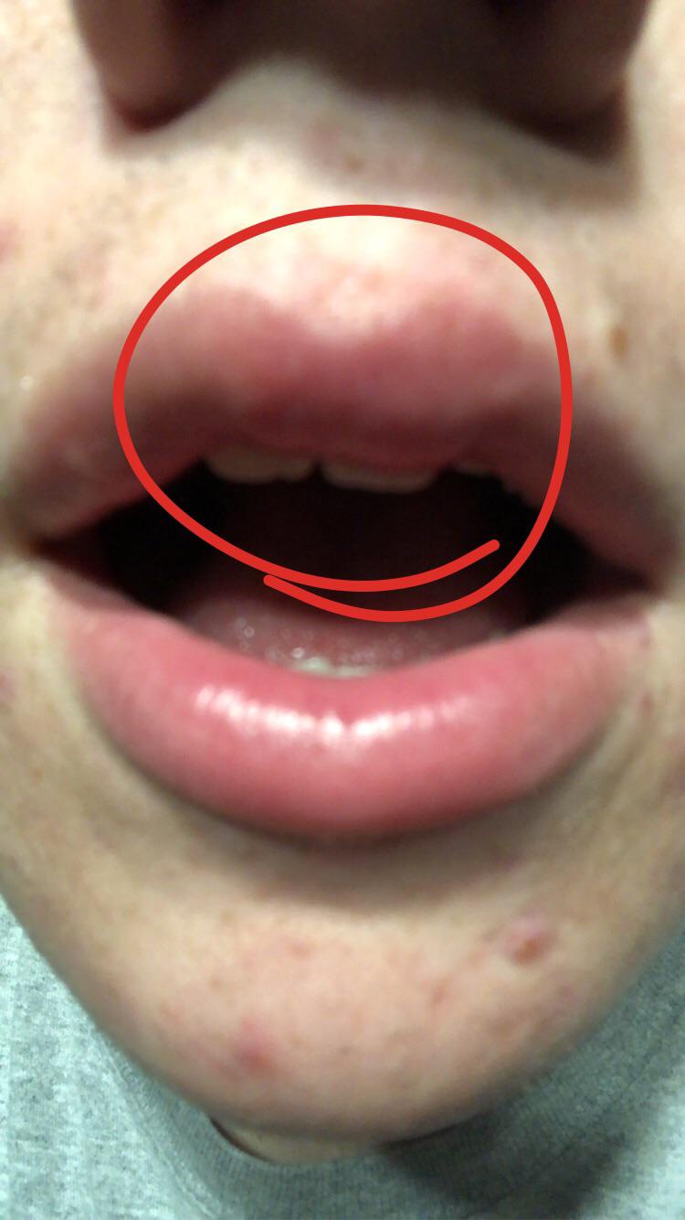 Confidence, community, and joy stocksy / design by camden dechert so you've tried the faux lip ring, and now. Anyone Know Why My Lip Swells Up And Gets Hard As A Rock Like This Sometimes When I Play Trumpet Especially If I Haven T Played The Previous Day R Trumpet