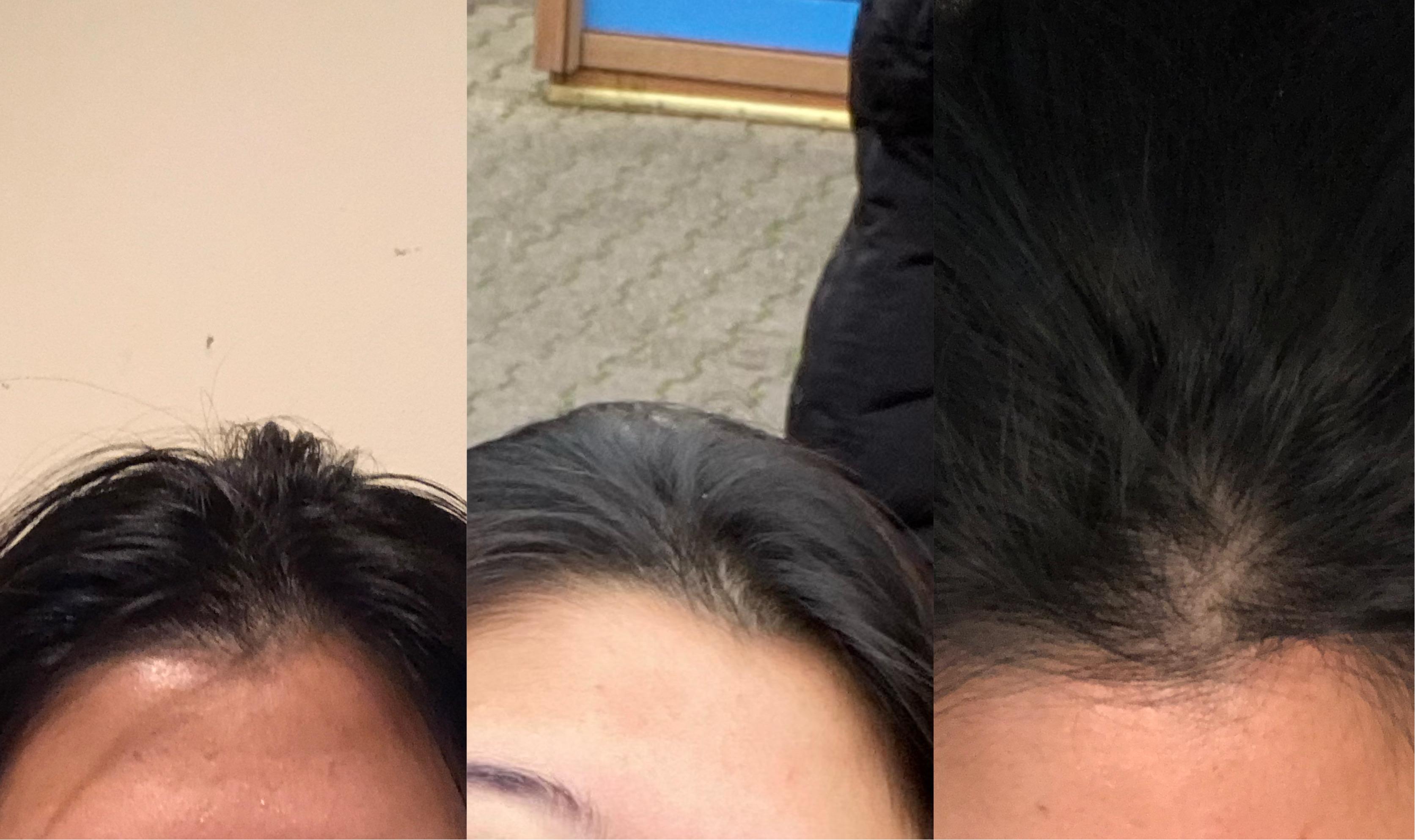 We did not find results for: My Hair Is Thinning At Widows Peak Small Bald Spot Any Suggestions For Hair Growth Femalehairadvice