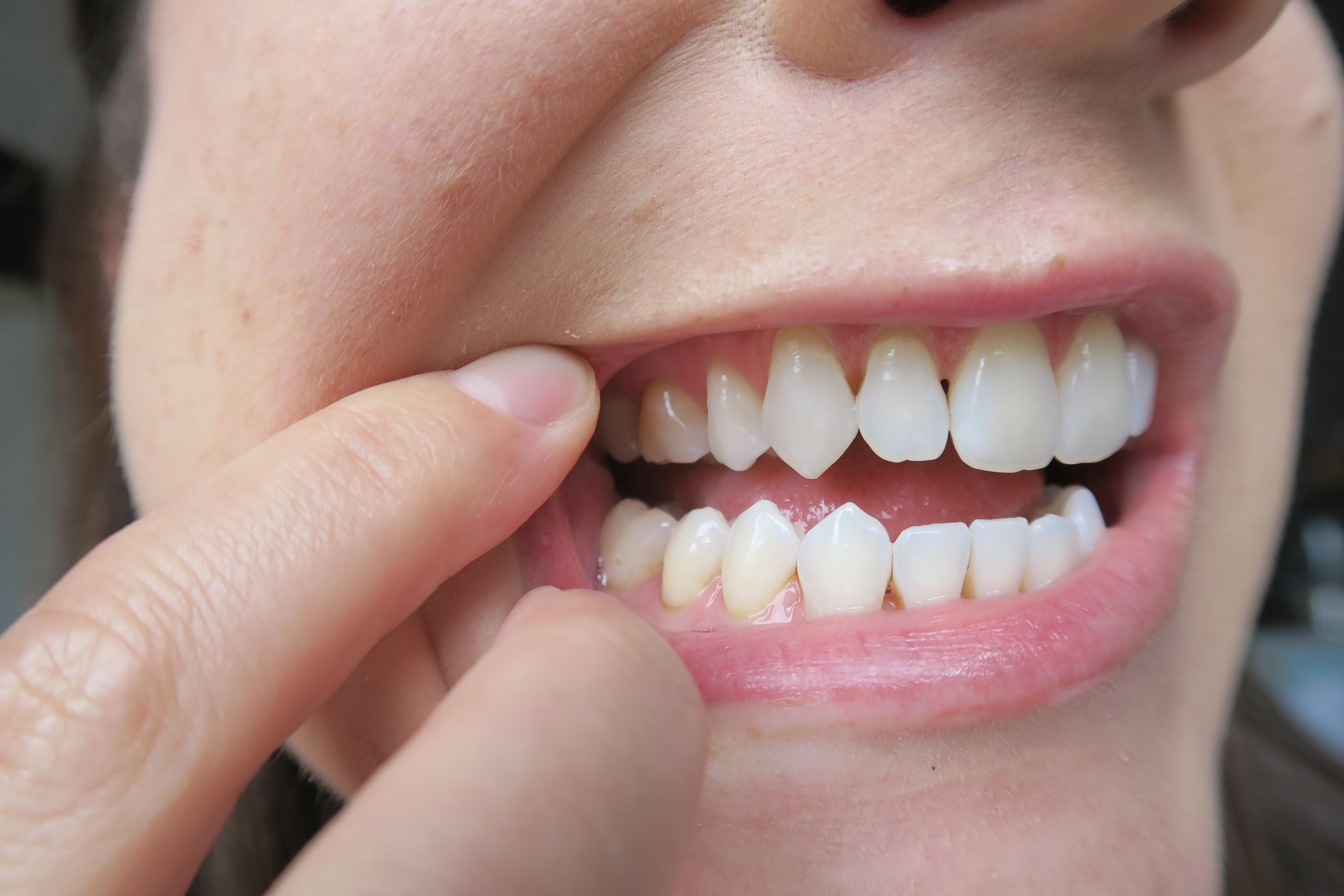 Home Remedies For Gum Disease Reddit