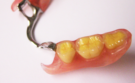 Dentier Flexible Prix  . Max Une Semaine Et Des Travaux Precis Et Artistique Prix Discount Apeller Le.