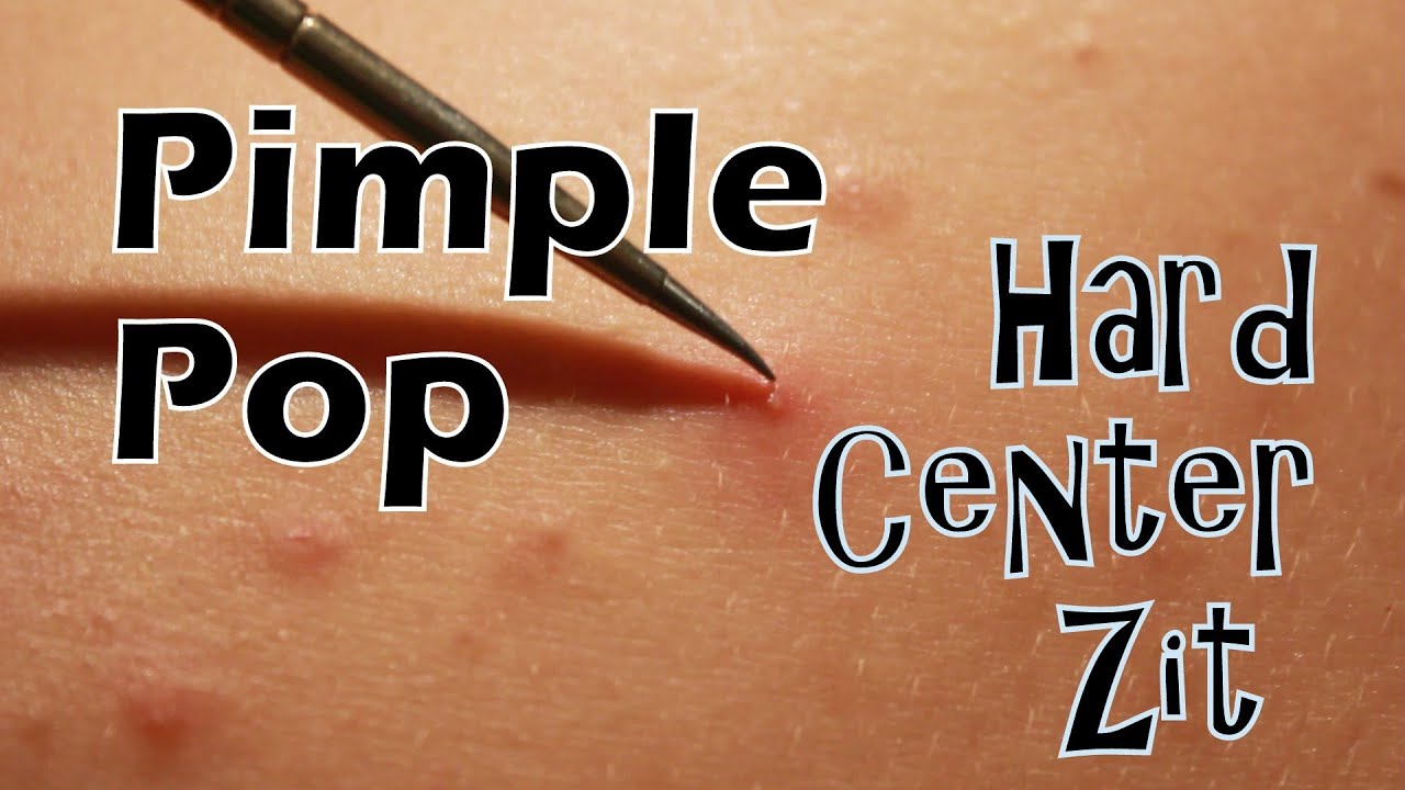 While your hands may be clean, your fingernails are probably teeming with. Pimple Pop - Hard Center Zit High Definition 1080p - YouTube