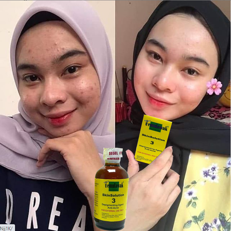 Kandungan bahan aktif di dalamnya mampu menghidrasi kulit, sehingga lebih . Original Bpom Temulawak Alcohol Anti Acne Wajah Bersih Glowing Tanpa Jerawat Dalam 5 Hari Menghilangkan Jerawat Bekas Jerawat Bruntusan Noda Hitam Serum Wajah Glowing Temulawak Asli Serum