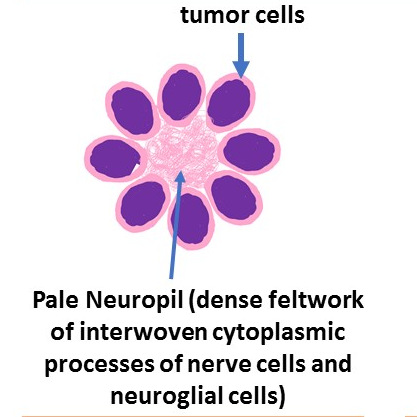 Fleurettes Retinoblastoma Histology : Pathology Of Retinoblastoma Pathology Made Simple