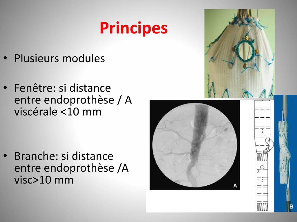 Ppt Anevrysmes Thoraco Abdominaux Traitement Endovasculaire Powerpoint Presentation Id 1837641