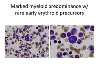 · pale skin · sleepiness · irritability · rapid heartbeat · heart murmur · physical defects of the face, head, neck, hands . Diamond Blackfan Anemia Aspirate
