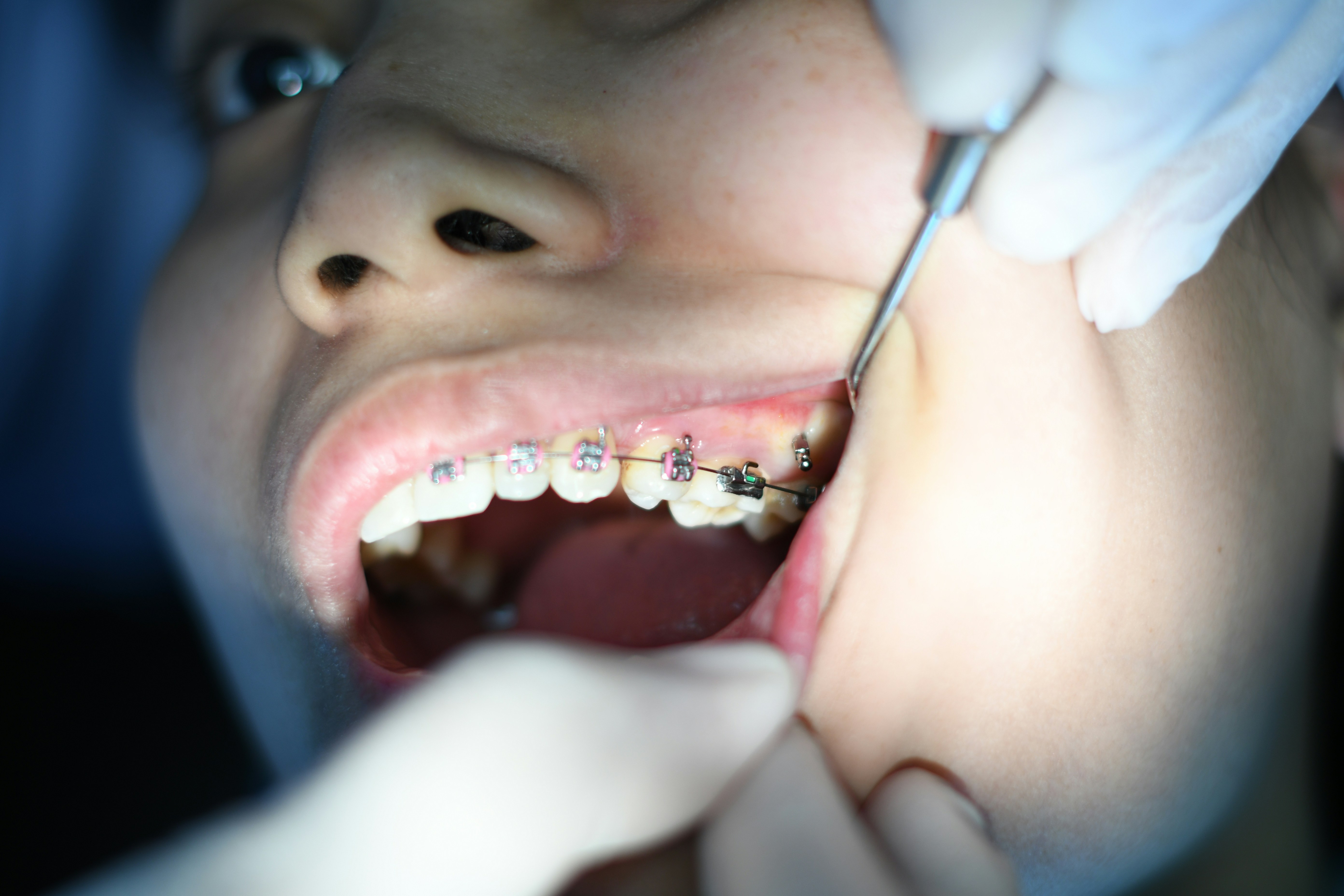 Do you Grind Your Teeth?