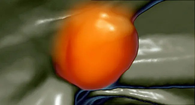 Nasal polyps may be treated with both surgical and medical therapies. Polyp Pictures What They Are And What Polyps Look Like