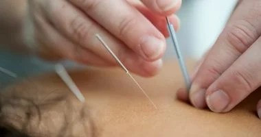جلسة وخز بالإبر تنتهى باكتشاف عشرات الإبر المكسورة فى قدم امرأة روسية