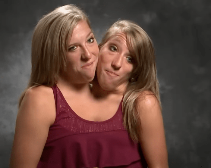 Abby and Brittany Conjoined Twins Now 2020: Have They Been Separated ...