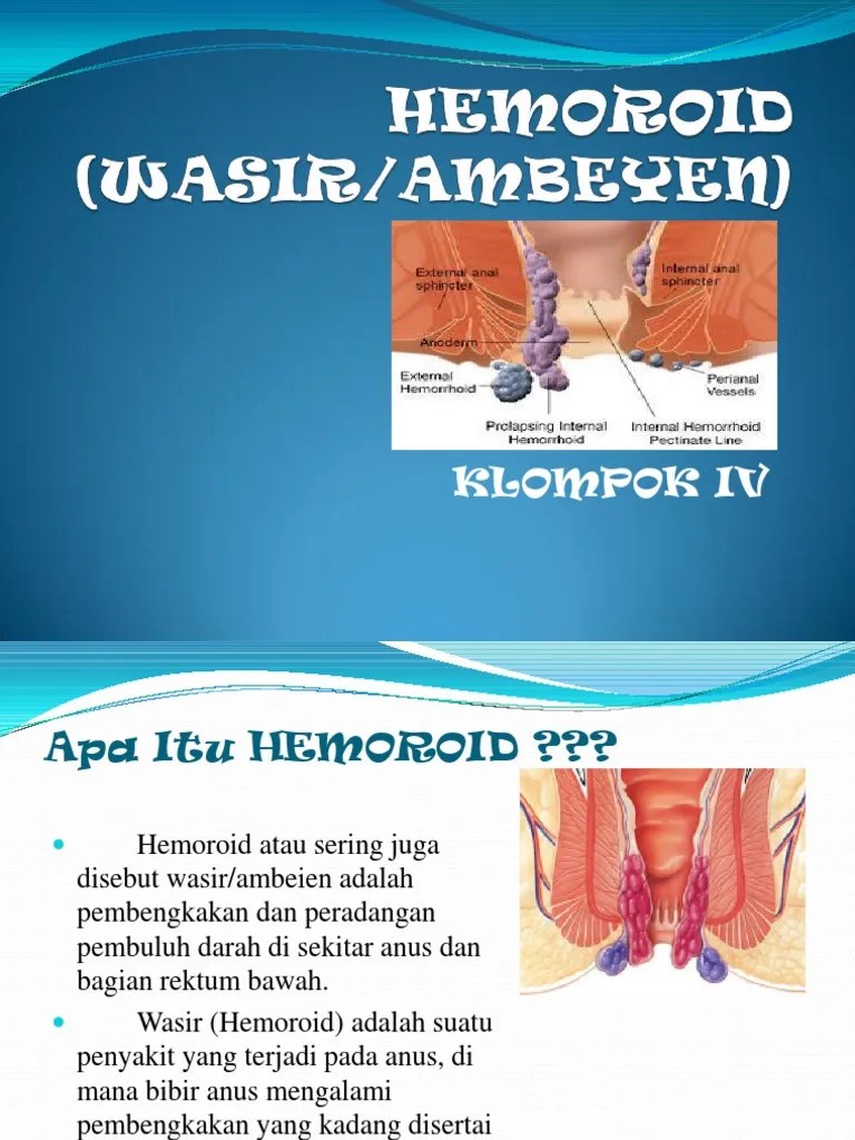 Hemoroid Adalah