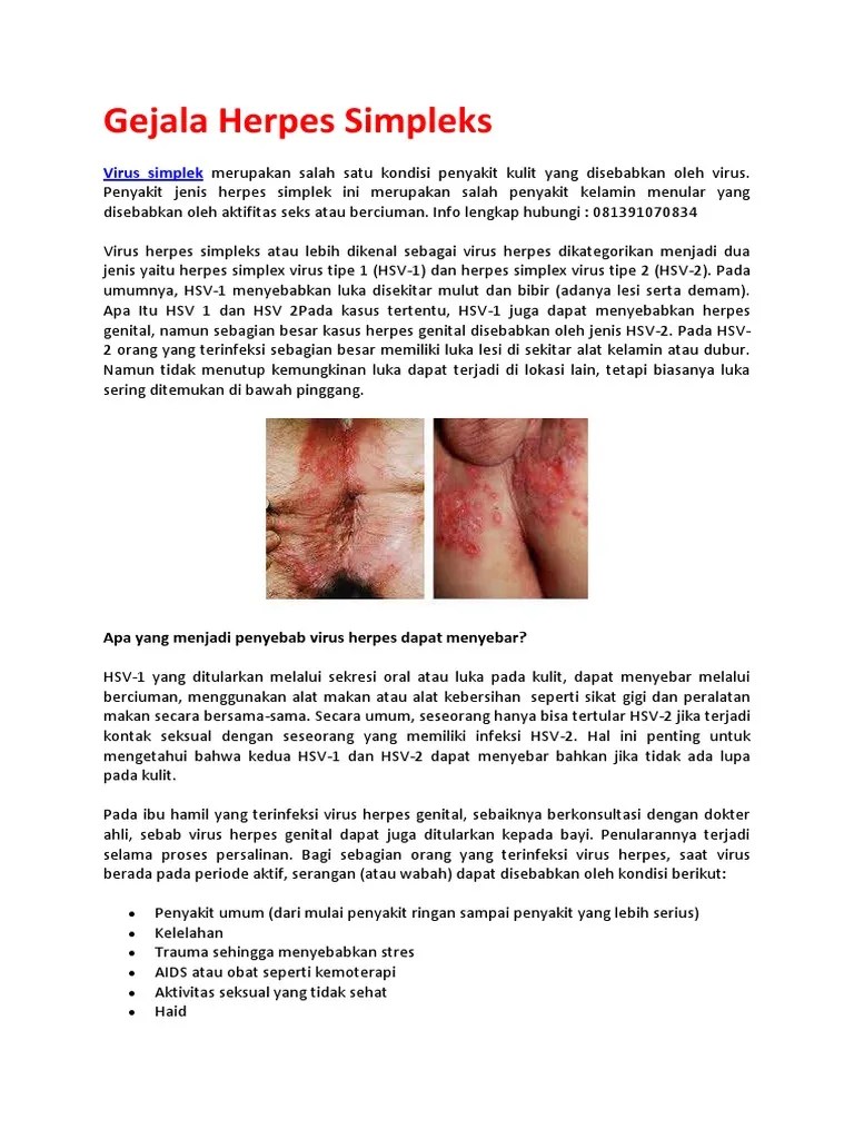 Gejala Herpes Simpleks | PDF