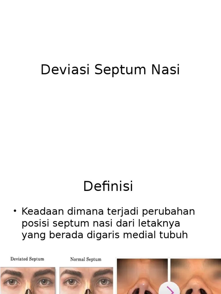 Deviasi Septum Nasi | PDF