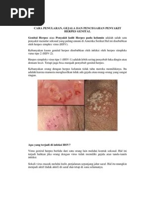 Cara Penularan Dan Pencegahan PENYAKIT HERPES | PDF