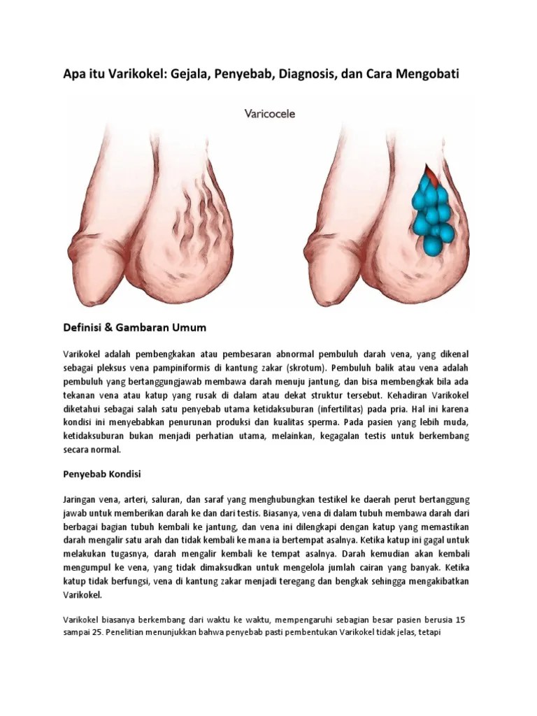 Varikokel | PDF
