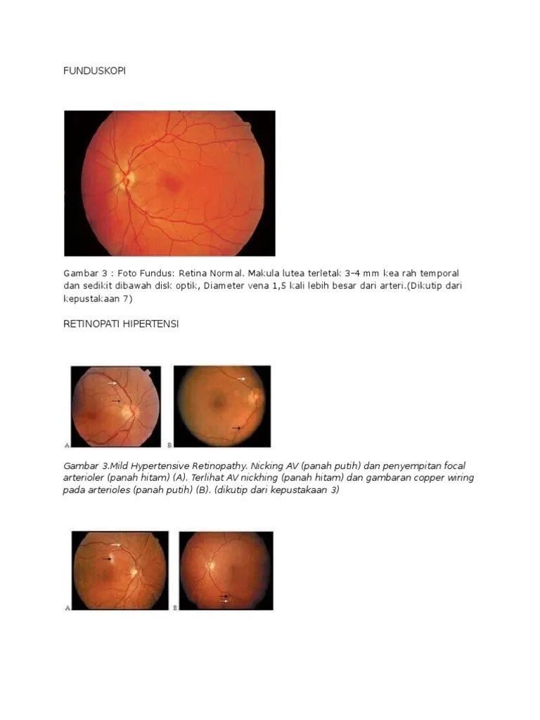 Funduskopi Mata | PDF