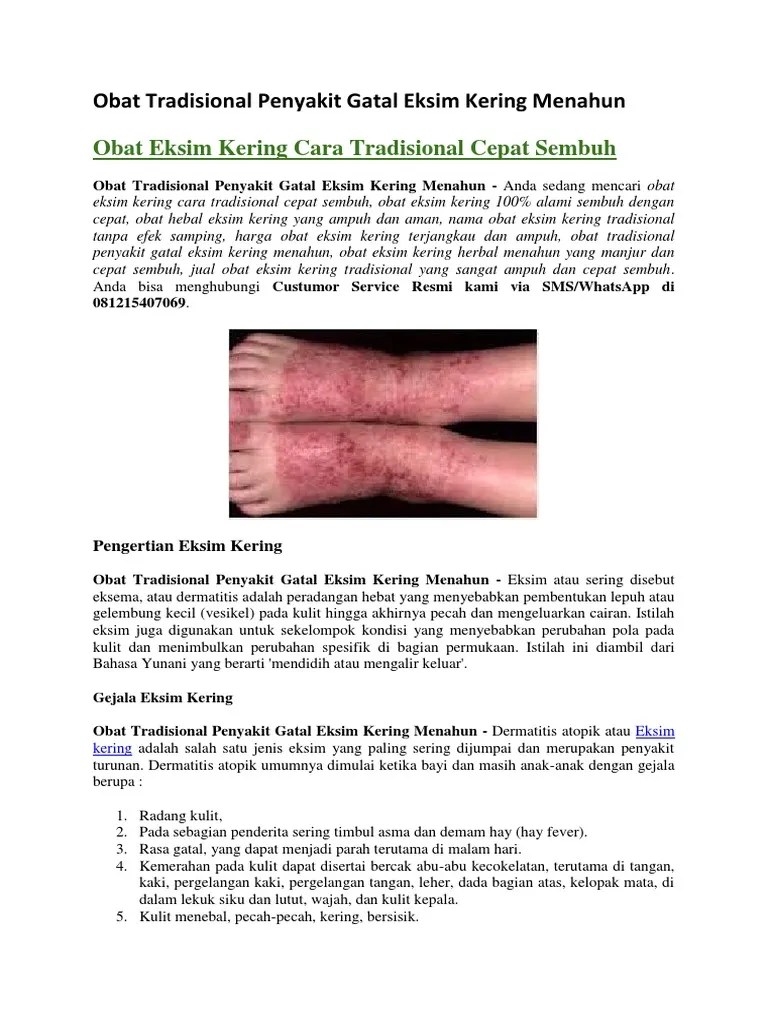 Asam lemak dalam minyak kelapa mampu melembabkan dan mengatasi kulit kering akibat eksim. Obat Tradisional Penyakit Gatal Eksim Kering Menahun Pdf