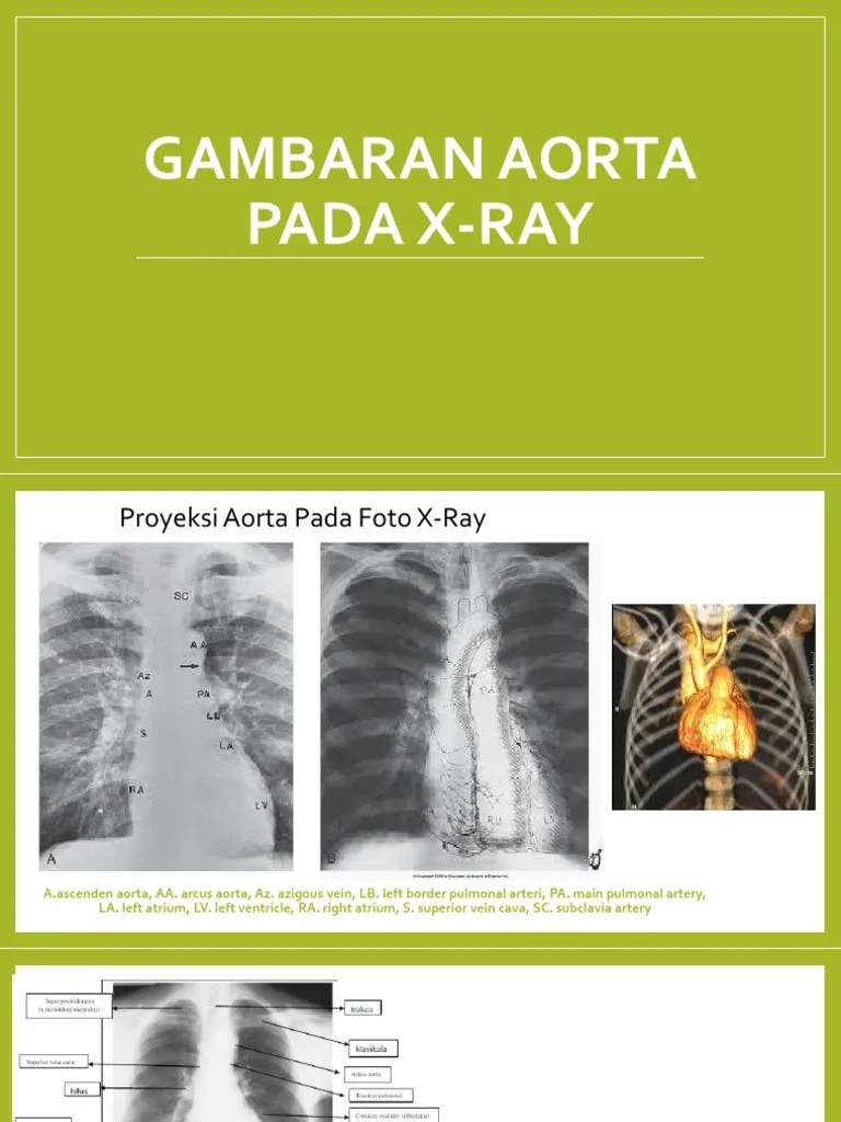 Gambaran Aorta Pada X-Ray | PDF