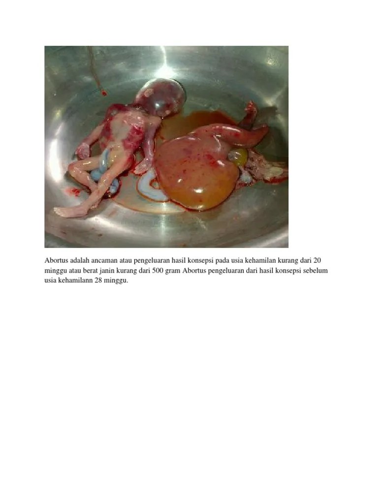 Abortus Adalah Ancaman Atau Pengeluaran Hasil Konsepsi Pada Usia Kehamilan  Kurang Dari 20 Minggu Atau Berat Janin Kurang Dari 500 Gram Abortus  Pengeluaran Dari Hasil Konsepsi Sebelum Usia Kehamilann 28 Minggu | PDF