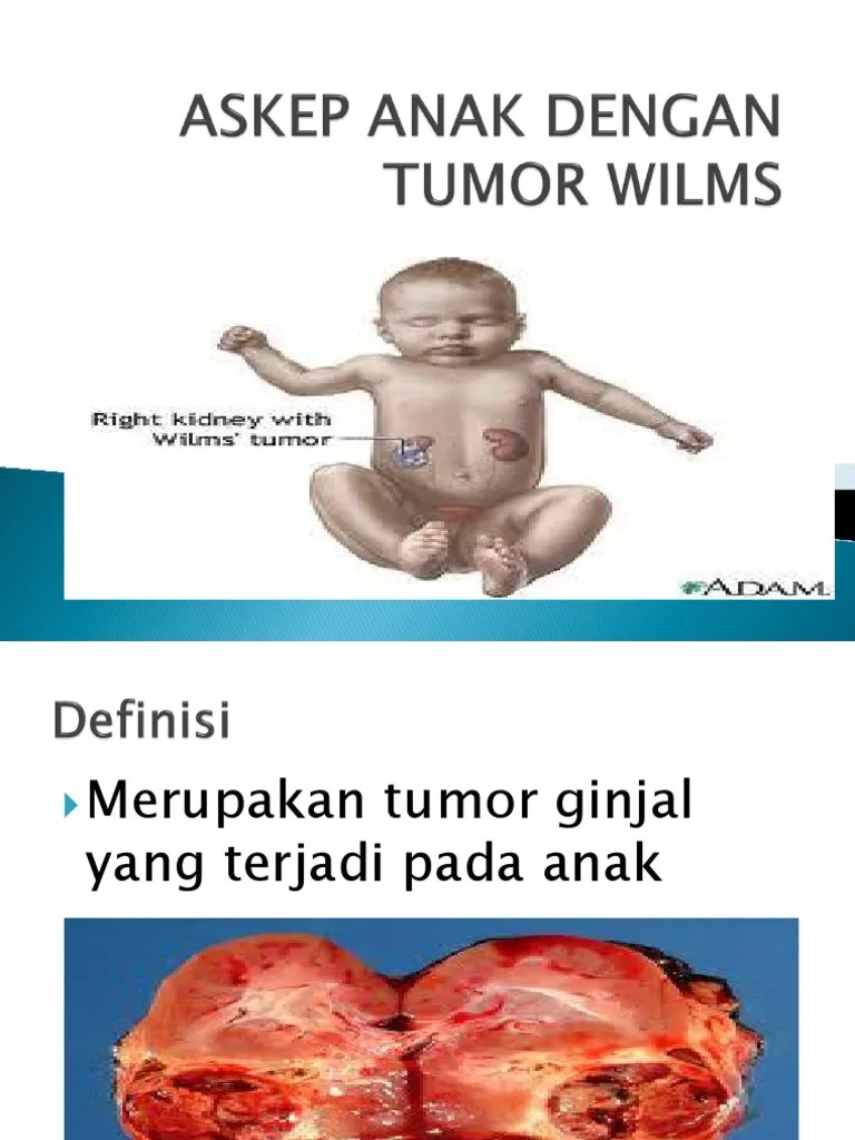 Askep Anak Dengan Tumor Wilms | PDF