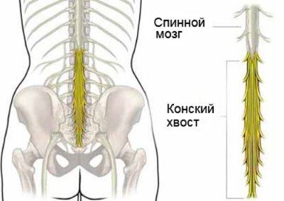 Как вылечить грыжу позвоночника без операции. Лечение грыжи позвононика без операции Как вылечить грыжу позвоночника навсегда