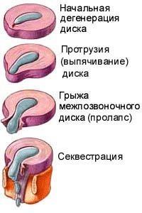 Как вылечить грыжу позвоночника без операции. Лечение грыжи позвононика без операции Как вылечить грыжу позвоночника навсегда