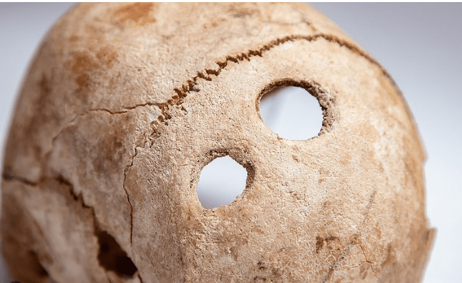 Holes in the skull: Skilled surgeons lived in ancient Moldova ...