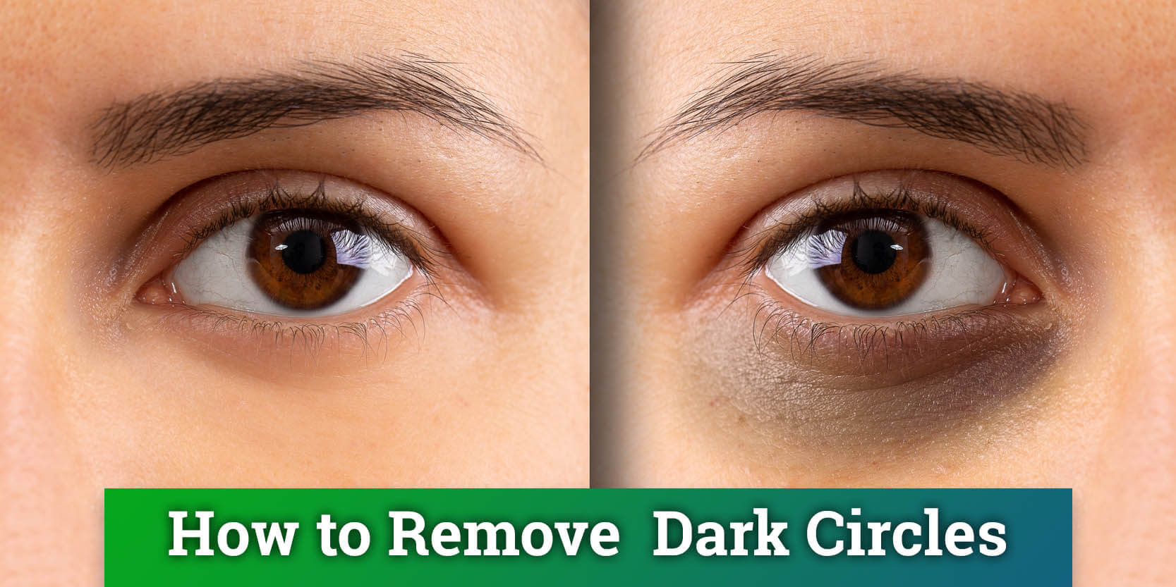 How To Get Rid Of Dark Rings Under My Eyes Effortlessly