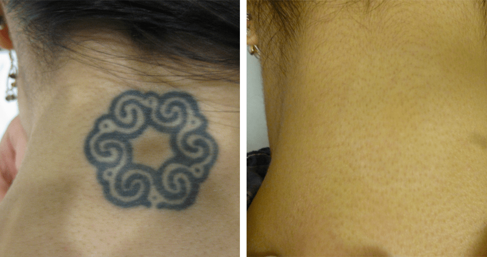 Why are these services free? Laser Tattoo Removal Cost Explained Ink B Gone Laser Tattoo Removal