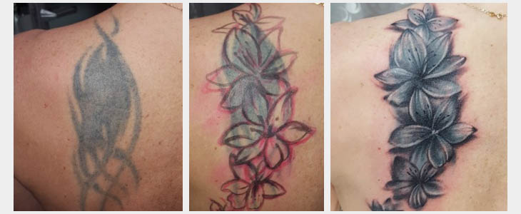 Rimozione Tatuaggio - Metodi, Risultati E Effetti Collaterali Delle Procedure 300_x_730_jpg